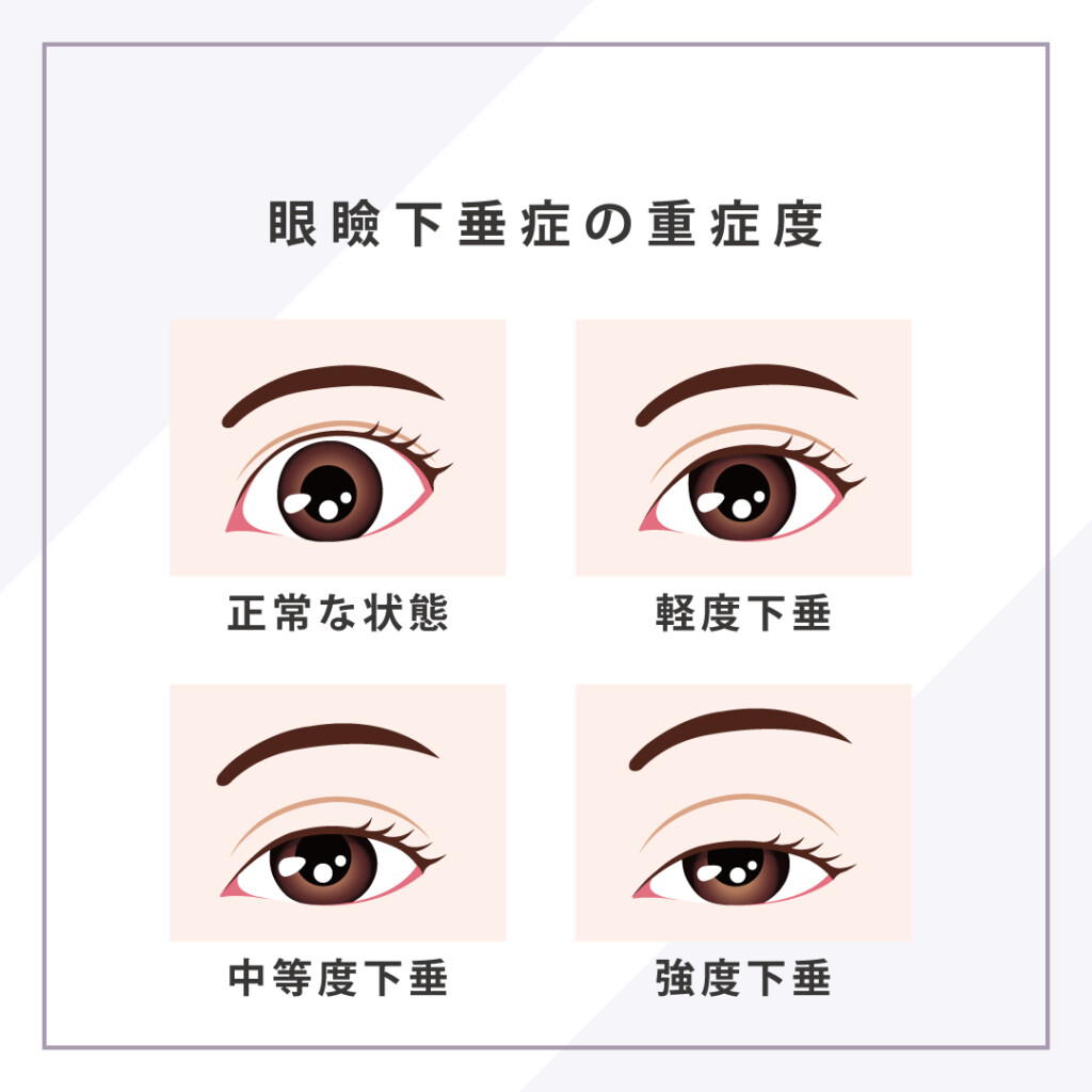 眼瞼下垂症の重症度